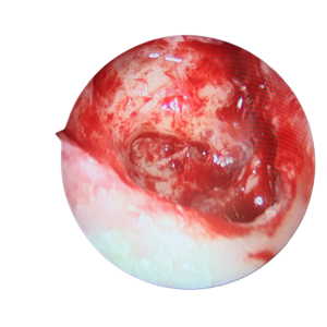 手術(shù)沒做干凈，術(shù)后3年顱內(nèi)竟發(fā)現(xiàn)巨大膽脂瘤！