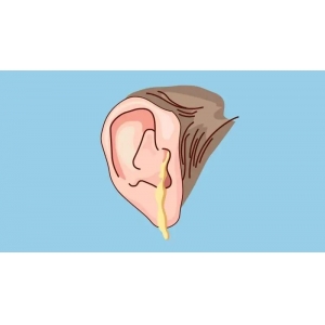 中耳膽脂瘤：隱藏在耳內(nèi)的“隱形殺手”