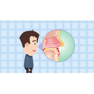 鼻息肉,鼻腔內(nèi)的“不速之客”