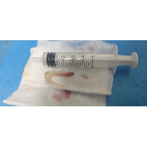 男子誤吞魚(yú)刺，術(shù)后取出3厘米長(zhǎng)倒置雙頭銳利魚(yú)骨，直呼僥幸得救！