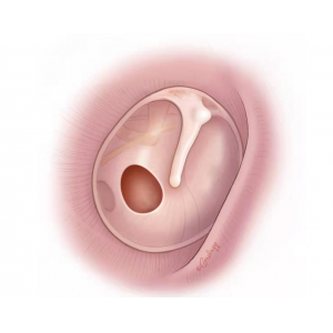鼓膜穿孔不及時治療，會導(dǎo)致聽力下降，甚至引發(fā)顱內(nèi)感染？