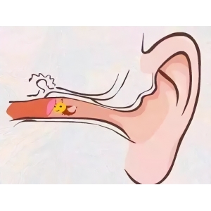 聽力下降絕非小事，若不及時干預(yù)，嚴(yán)重會導(dǎo)致耳聾