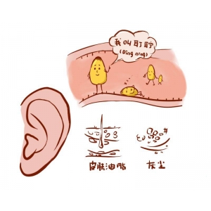 耳朵里耳屎多，到底要不要掏，正確處理方式是？