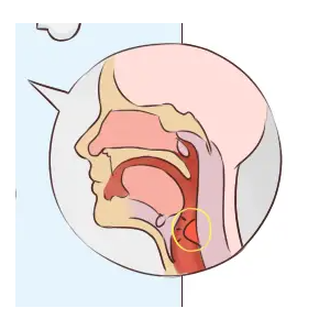 咽喉炎若不及時治療，可能會引發(fā)一系列并發(fā)癥