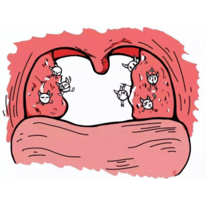 切除扁桃體會對身體產(chǎn)生危害嗎？