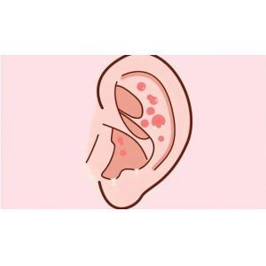 得了外耳道濕疹，怎么辦，快試試這三個(gè)方法