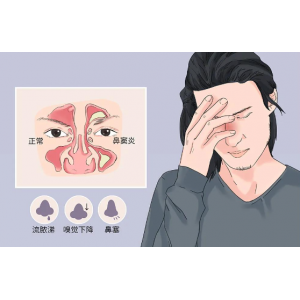 為什么感冒容易導(dǎo)致鼻竇炎，鼻竇炎該如何預(yù)防？
