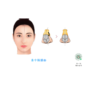 兒童鼻中隔能矯正？最佳干預(yù)年齡！