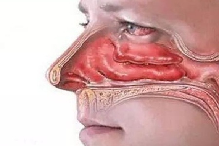 (貴陽(yáng)治療鼻竇炎哪個(gè)醫(yī)院好)貴陽(yáng)看鼻竇炎那家醫(yī)院好(圖2) (貴陽(yáng)治療鼻竇炎哪個(gè)醫(yī)院好)貴陽(yáng)看鼻竇炎那家醫(yī)院好(圖2)