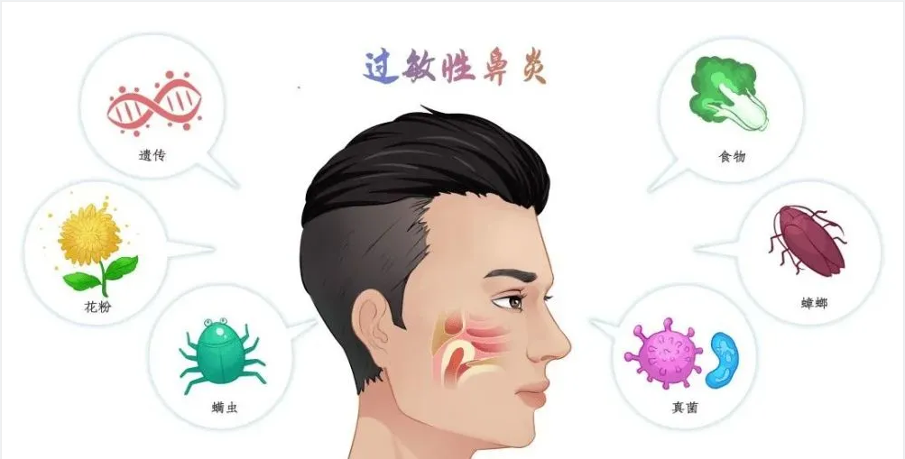 銘仁耳鼻喉專家分享：如何一招解決過敏性鼻炎的打噴嚏流鼻涕！(圖1)