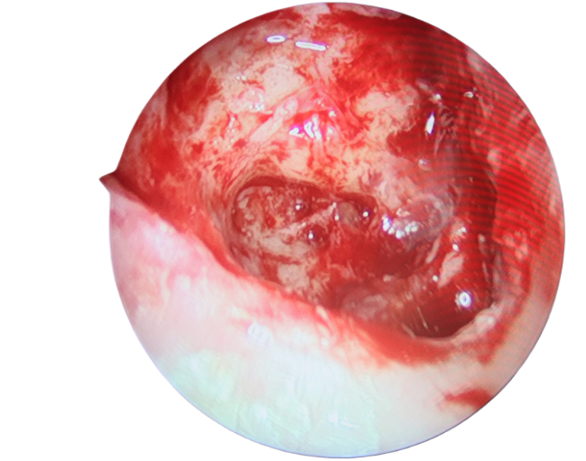 手術(shù)沒做干凈，術(shù)后3年顱內(nèi)竟發(fā)現(xiàn)巨大膽脂瘤！(圖1)