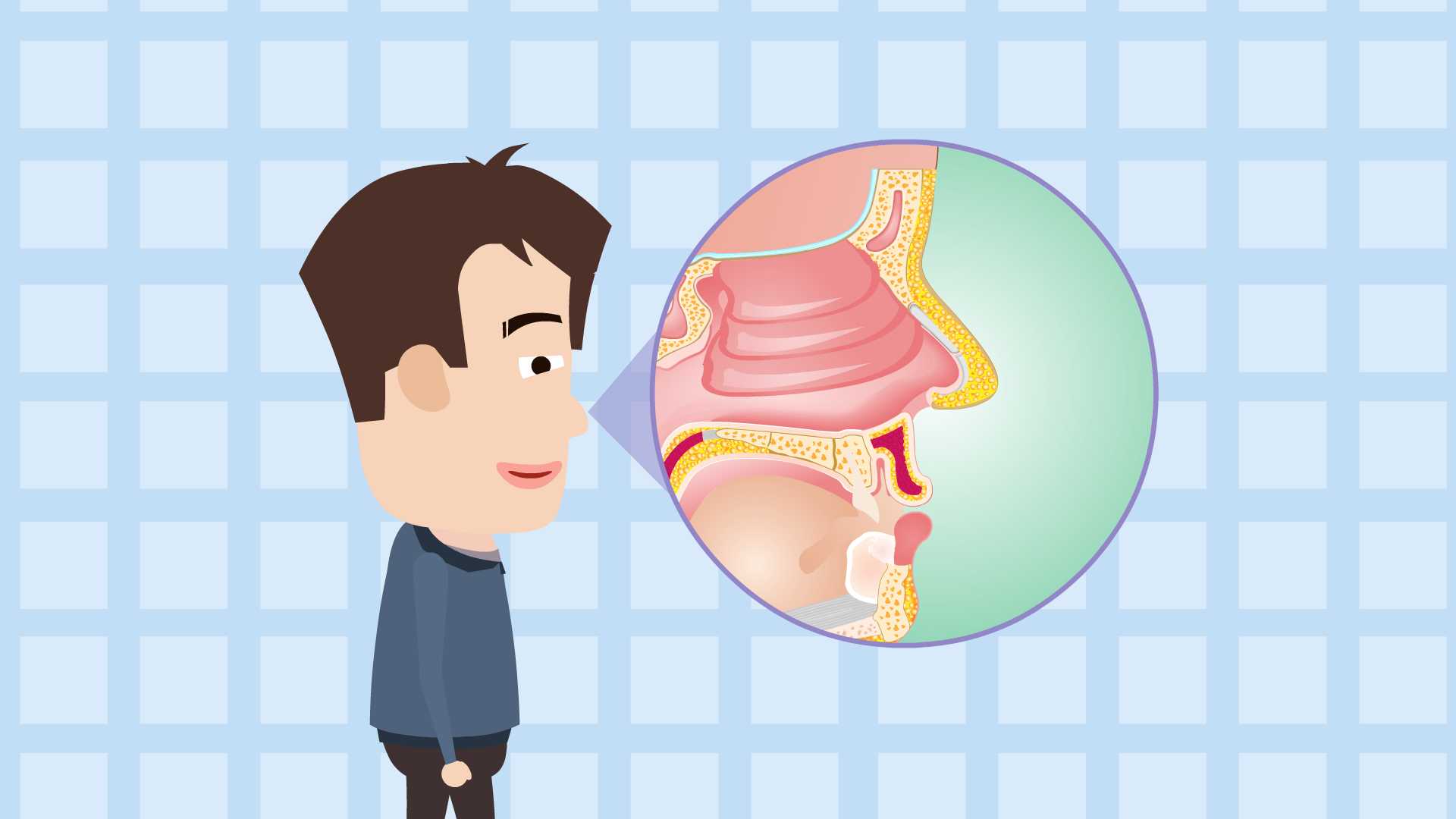 鼻息肉,鼻腔內(nèi)的“不速之客”(圖1) 鼻息肉,鼻腔內(nèi)的“不速之客”(圖1)