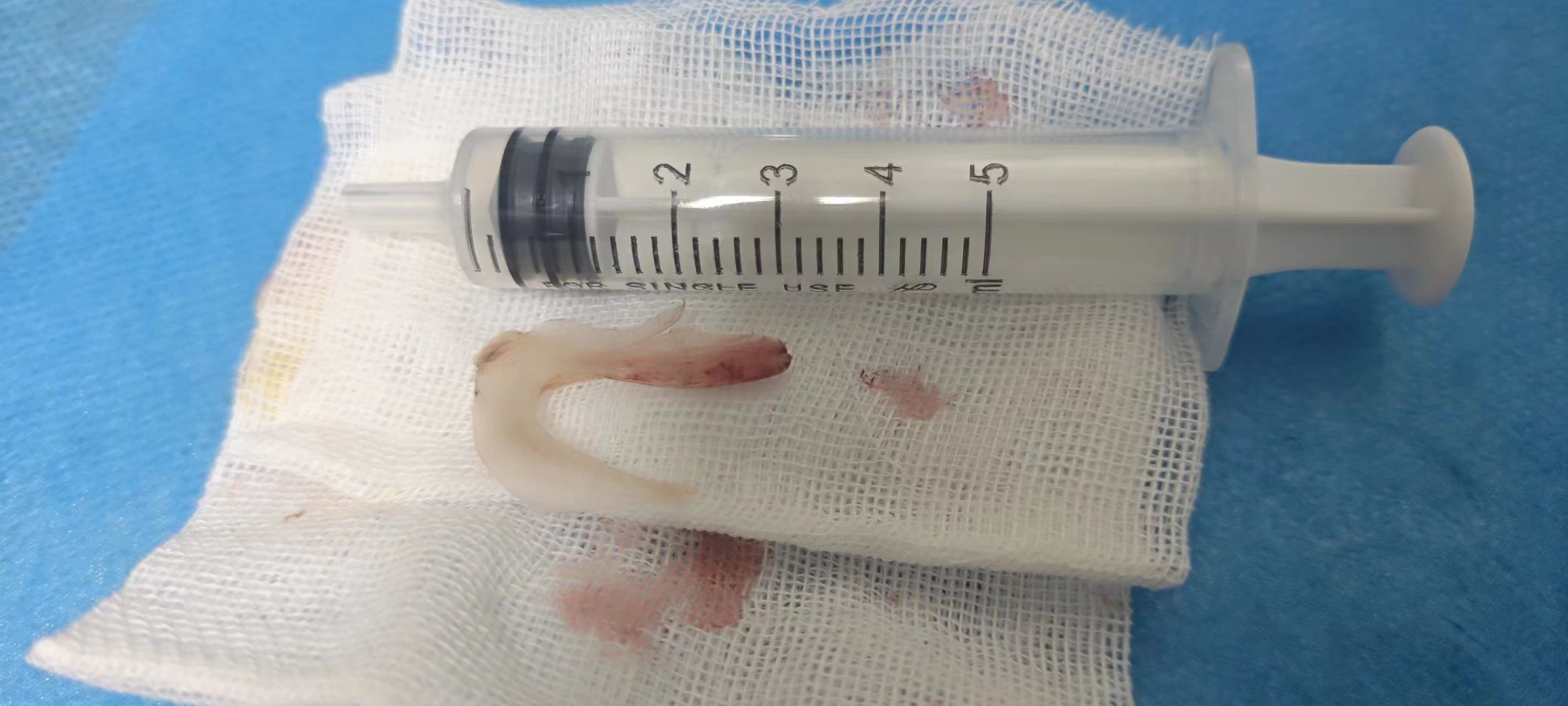 男子誤吞魚刺，術(shù)后取出3厘米長(zhǎng)倒置雙頭銳利魚骨，直呼僥幸得救！(圖1)