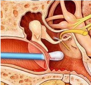 鼓膜穿孔不及時治療，會導(dǎo)致聽力下降，甚至引發(fā)顱內(nèi)感染？(圖2)