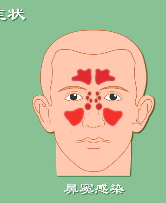 從腺樣體肥大到鼻竇炎，家長要小心這三步！(圖3)