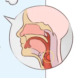 咽喉炎若不及時(shí)治療，可能會(huì)引發(fā)一系列并發(fā)癥(圖1)