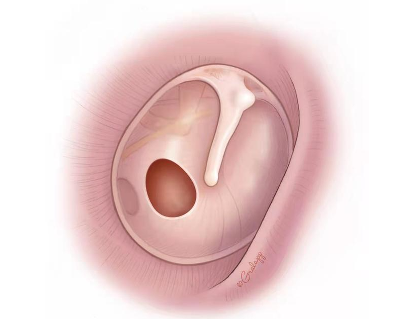 鼓膜穿孔的危害：聽(tīng)力受損與并發(fā)癥的連鎖反應(yīng)(圖1)