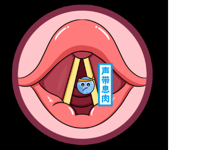 聲帶息肉，就像是聲帶長(zhǎng)出了一個(gè)“小肉球”(圖2)