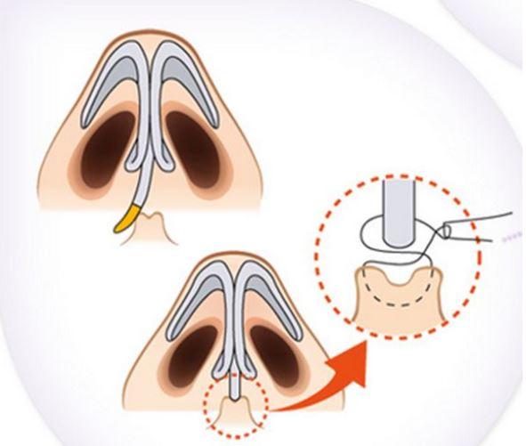 鼻中隔偏曲會導致睡眠障礙，甚至誘發(fā)心血管疾??？(圖1)