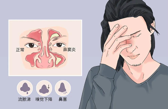 鼻竇炎不及時(shí)治療，會(huì)危及生命？？？(圖2)