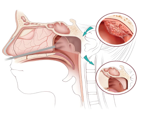 鼻塞，不只是感冒那么簡單(圖2)