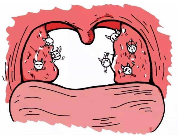 切除扁桃體會(huì)對(duì)身體產(chǎn)生危害嗎？(圖1)