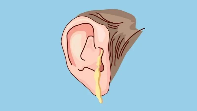 中耳炎會引起面癱，是真的嗎？(圖2)