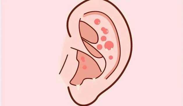 得了外耳道濕疹，怎么辦，快試試這三個(gè)方法(圖1)