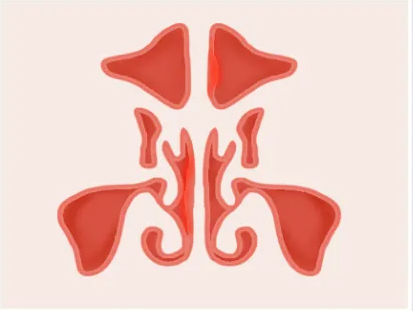 兒童鼻竇炎危害大，不要再當(dāng)普通感冒治療了(圖1)