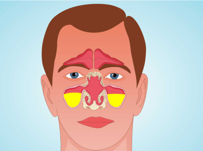 兒童鼻竇炎危害大，不要再當(dāng)普通感冒治療了(圖2)