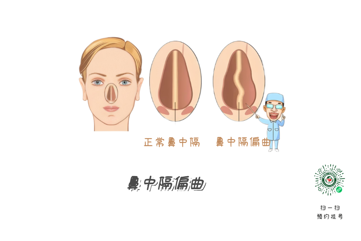 鼻塞、流涕、打噴嚏，是鼻炎引起的？注意可能是鼻中隔偏曲！(圖1)