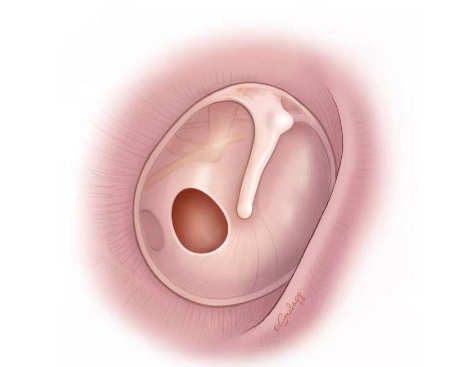 耳朵里破了個洞，影響大嗎？(圖1)