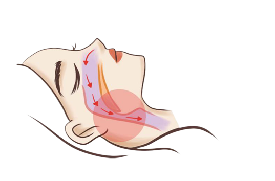 銘仁微創(chuàng)治療治好“呼嚕娃”，讓孩子不在打鼾！(圖1)