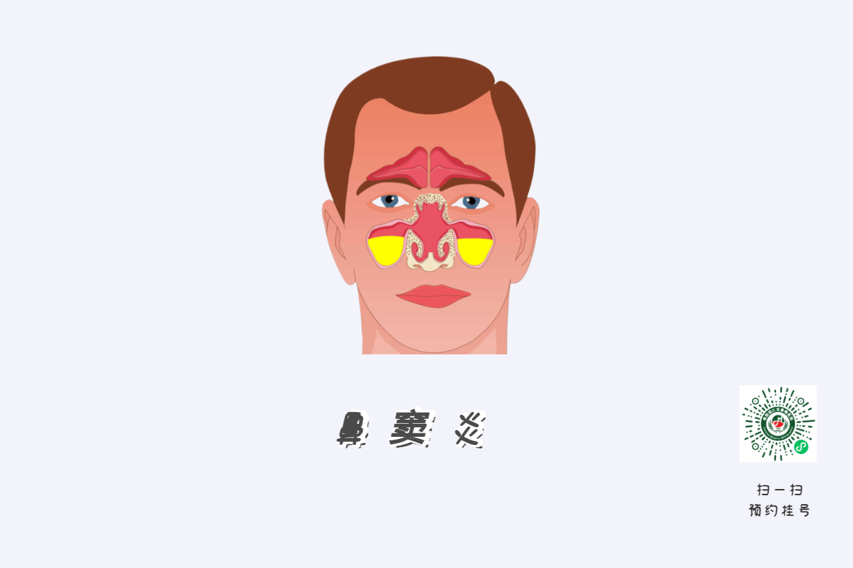 鼻竇炎頭痛有特點(diǎn)！這個(gè)位置痛要當(dāng)心(圖1)