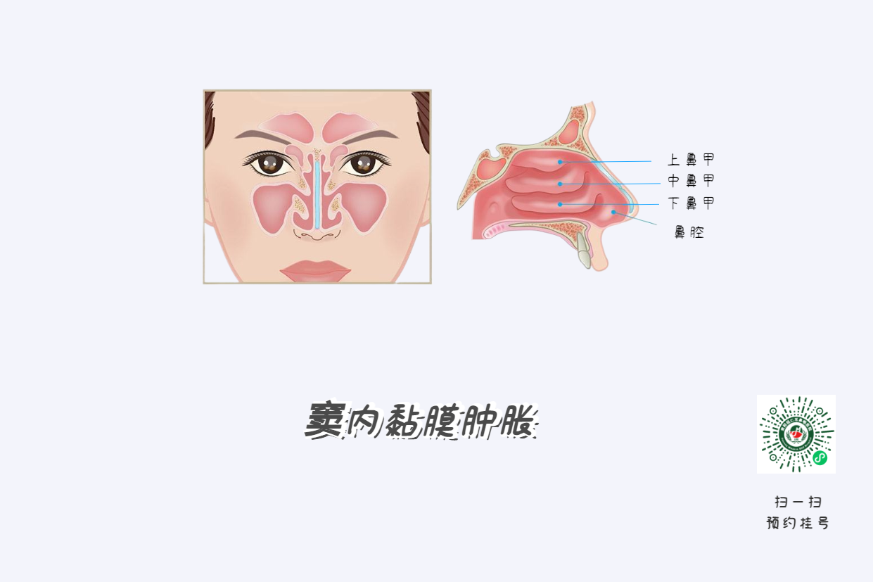 鼻竇炎頭痛有特點(diǎn)！這個(gè)位置痛要當(dāng)心(圖4)