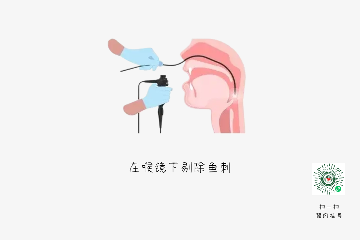 喉嚨卡魚刺？喝醋吞飯都是致命錯誤(圖2)