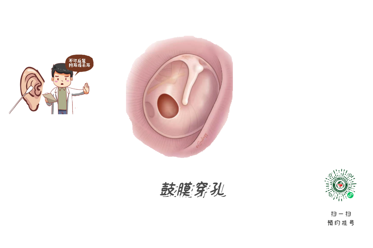 掏耳朵竟致顱內感染？這5個習慣快改掉(圖2)