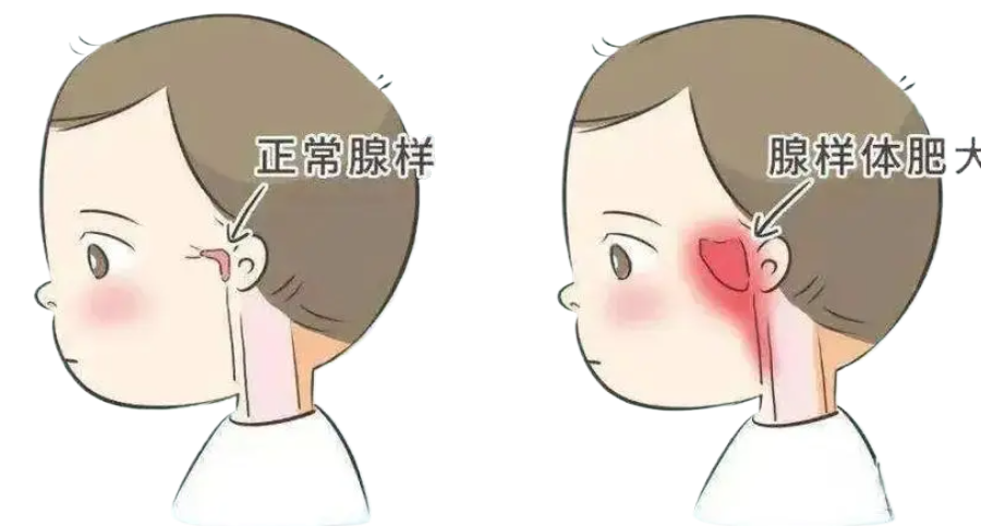 孩子腺樣體肥大影響發(fā)育和容貌，趁五一假期，微創(chuàng)治療快速治愈！(圖1)