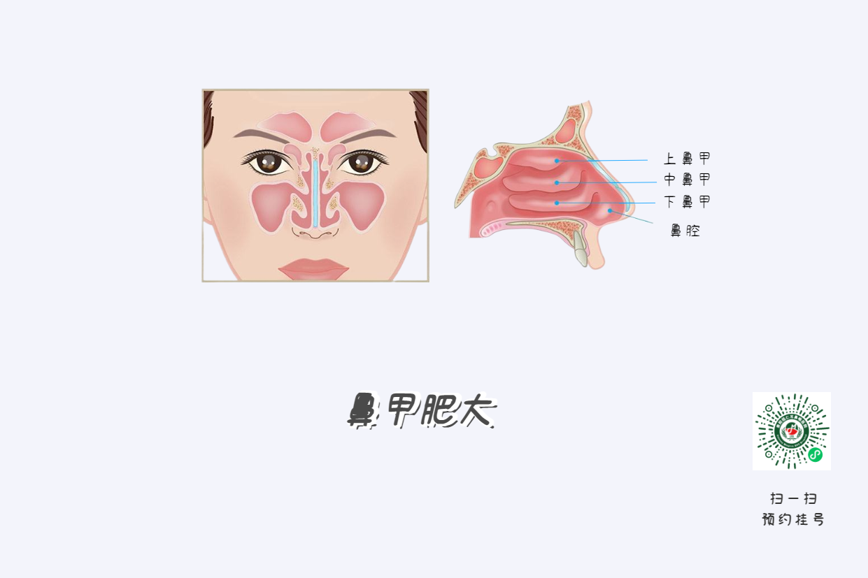 頭痛欲裂？可能是鼻竇炎在作祟！(圖2)