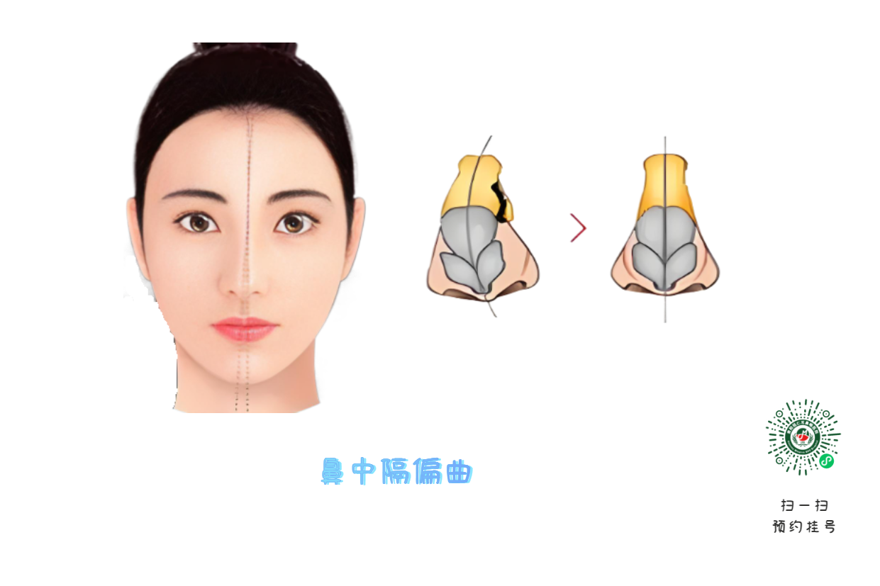 十年鼻塞不見好？問題可能出在“鼻梁歪了”！(圖1)